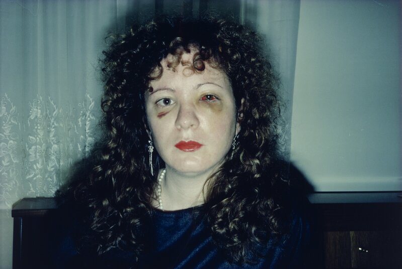 Nan Goldin | Nan One Month After Being Battered (1984) | Artsy