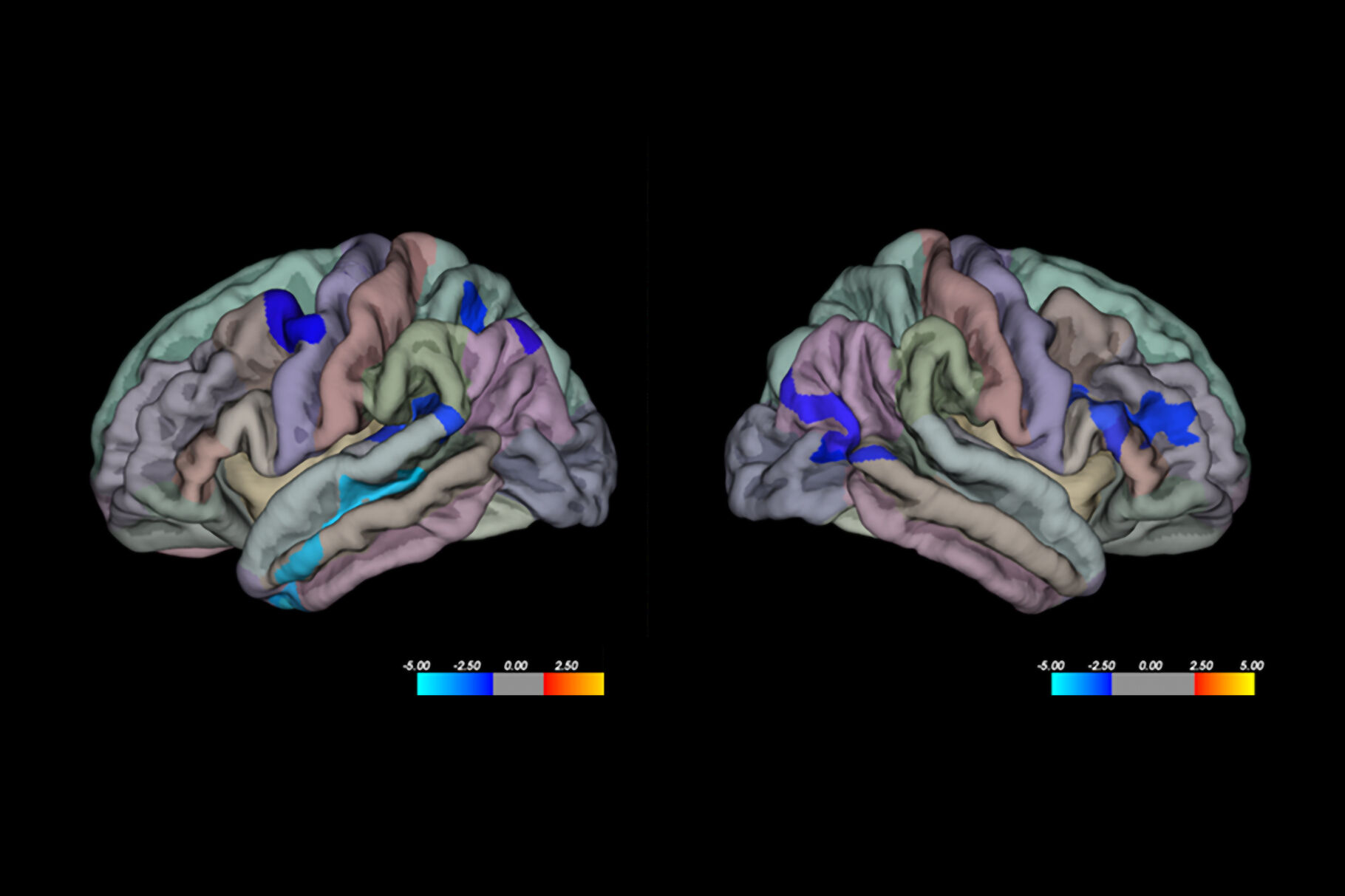 New Study Suggests a Link between Creativity and Brain Structure | Artsy