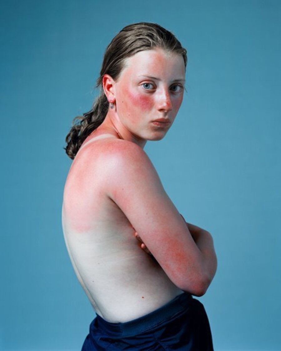 Sunburn