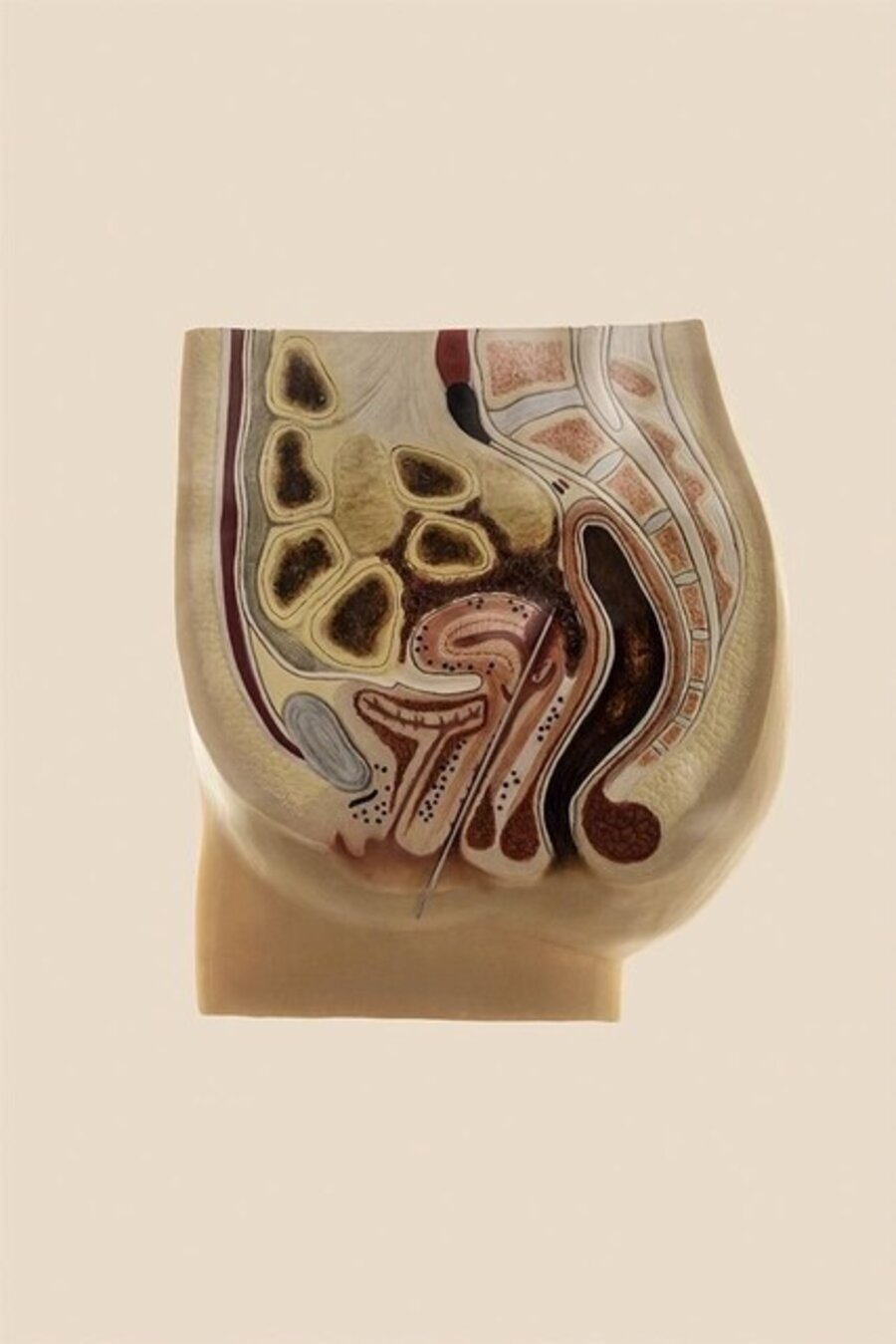 KNITTING NEEDLE PROCEDURE