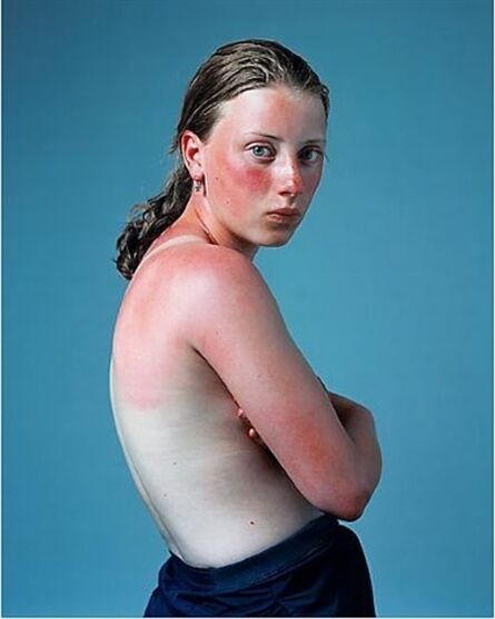 Hendrik Kerstens, ‘Sunburnt’, 2011