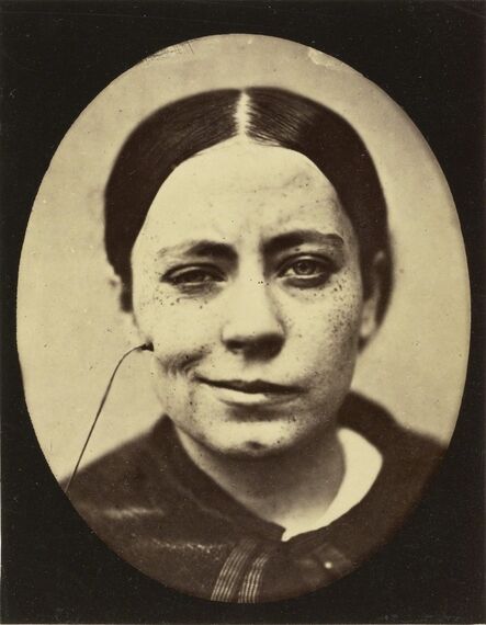 Guillaume Benjamin Armand Duchenne de Boulogne, ‘Electro-Physiologie Photographique (Portrait of a Woman), Fig. 35’, 1876