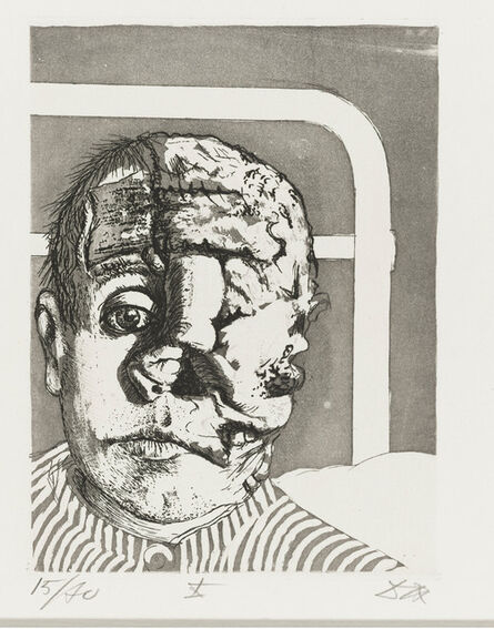 Otto Dix, ‘Skin Graft (Transplantation) from the Portfolio War (Der Krieg)’, 1924